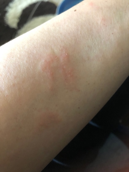 Adult eczema can start anywhere like on my arm.